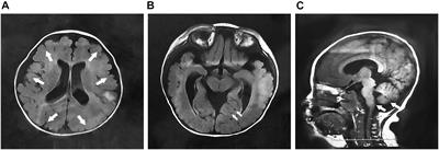 Phenotype and Genotype Study of Chinese POMT2-Related α-Dystroglycanopathy